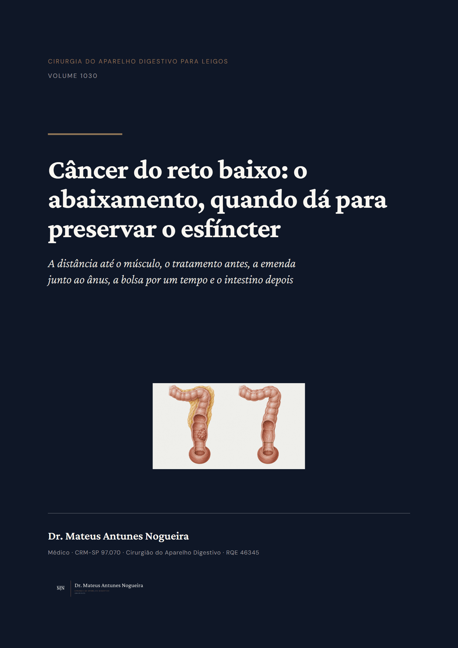 Capa do livro Câncer do reto baixo: o abaixamento, quando dá para preservar o esfíncter