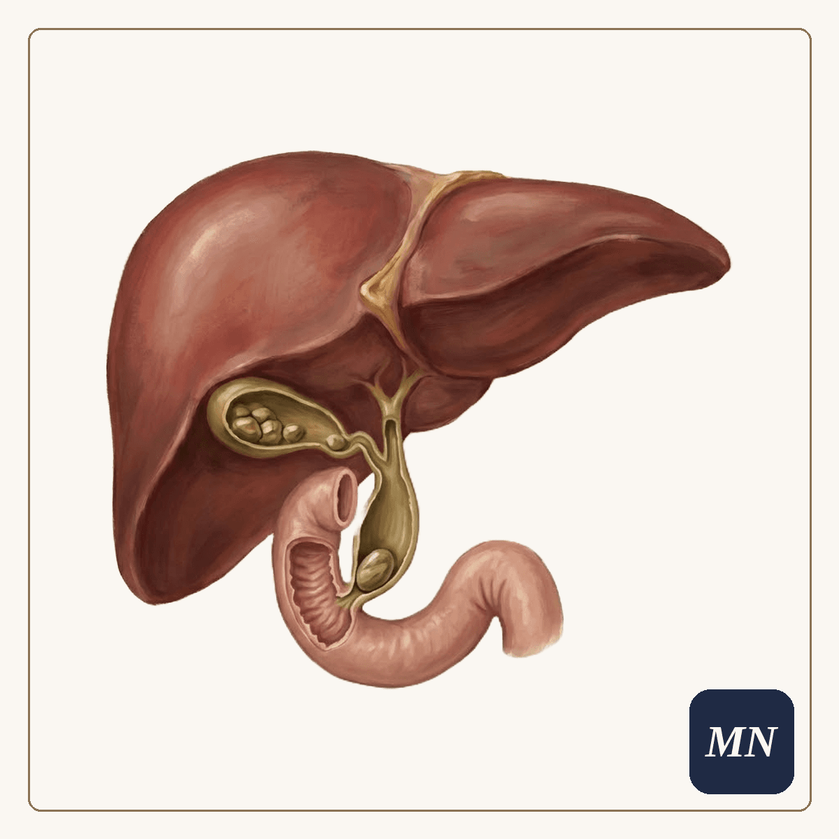 Ilustração anatômica — Cálculos nas vias biliares (coledocolitíase)