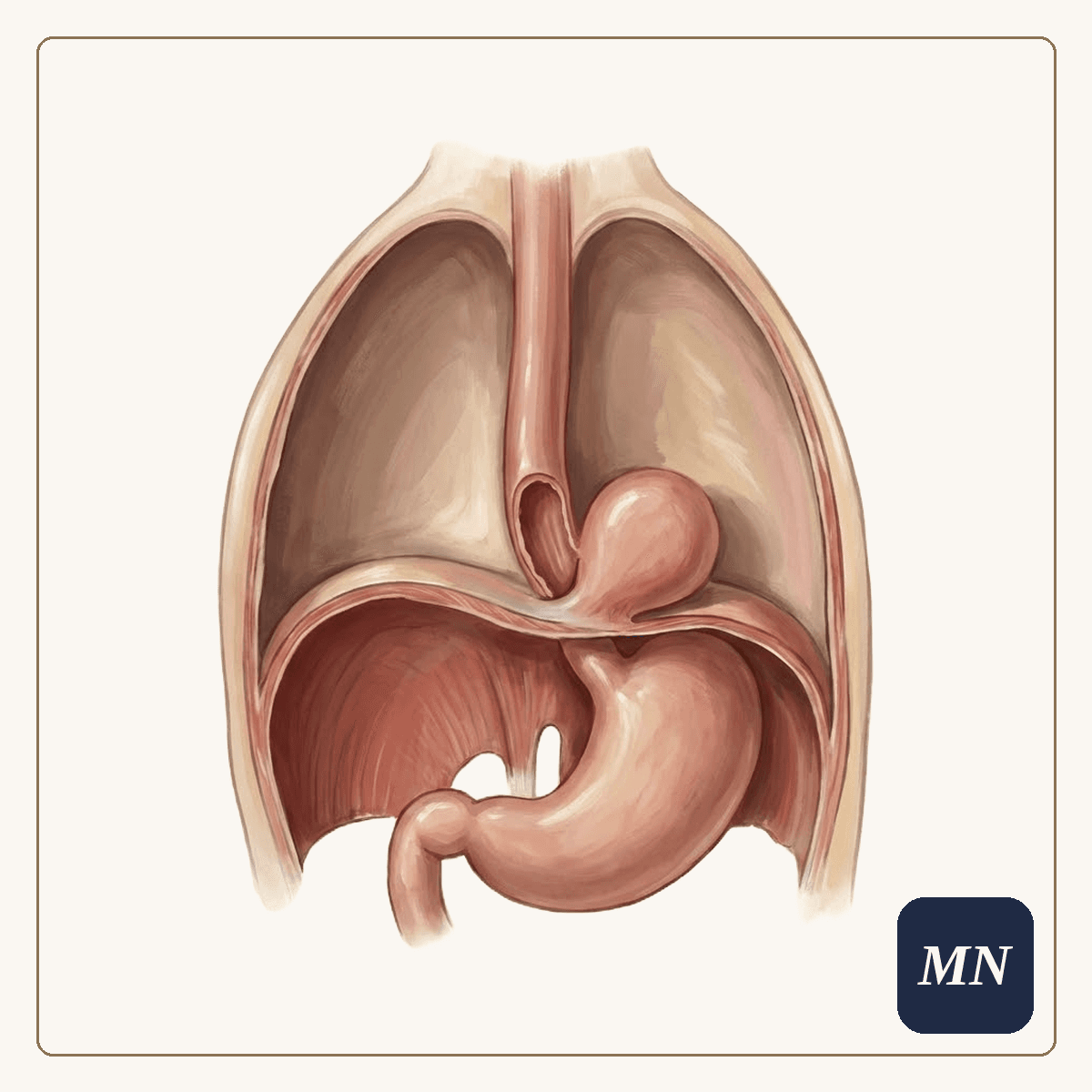 Ilustração anatômica — Hérnia de hiato