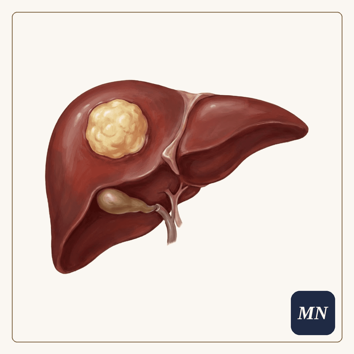 Ilustração anatômica — Câncer de fígado